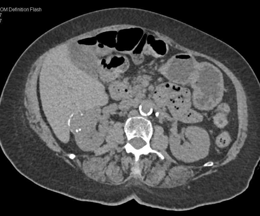 Complex Cyst Right Kidney - CTisus CT Scan