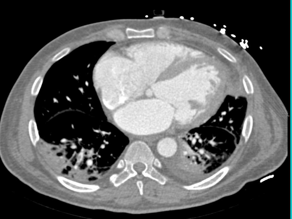 Left Renal Infarction with Multiple Vessel Thrombi - CTisus CT Scan