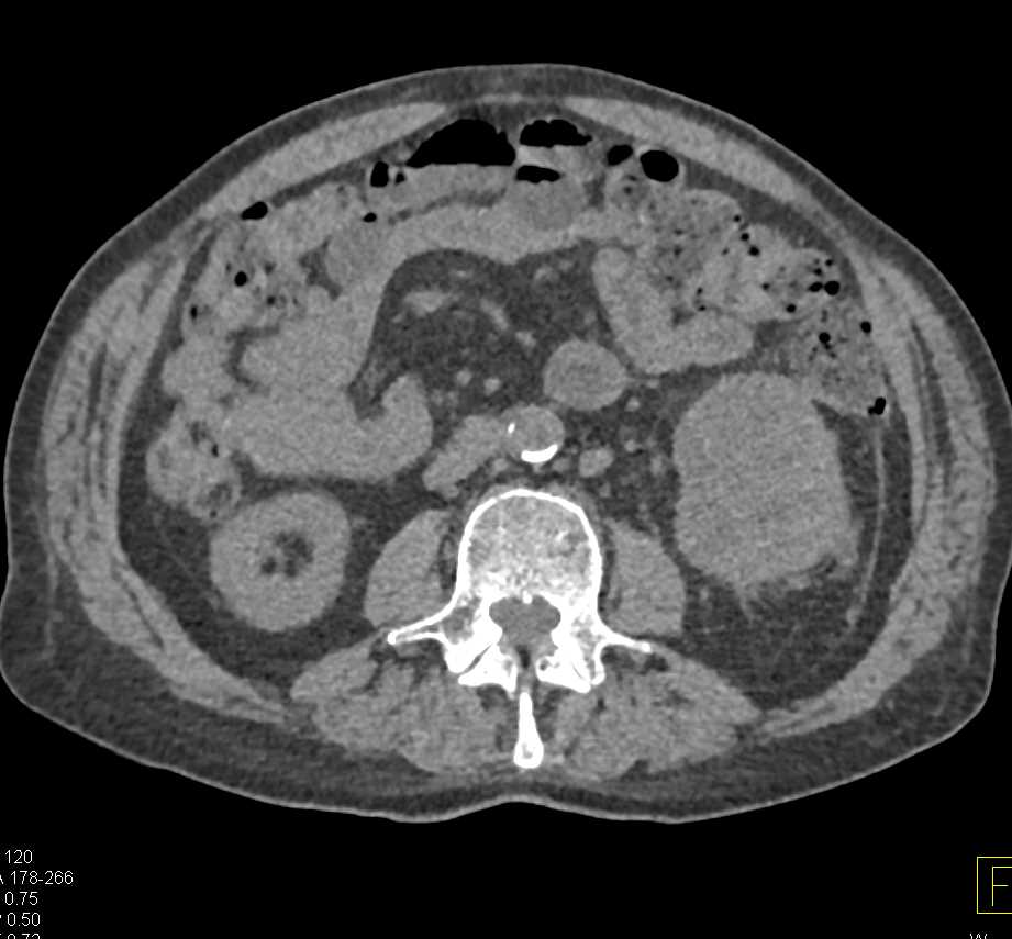 Cystic Left Renal Cell Carcinoma - CTisus CT Scan