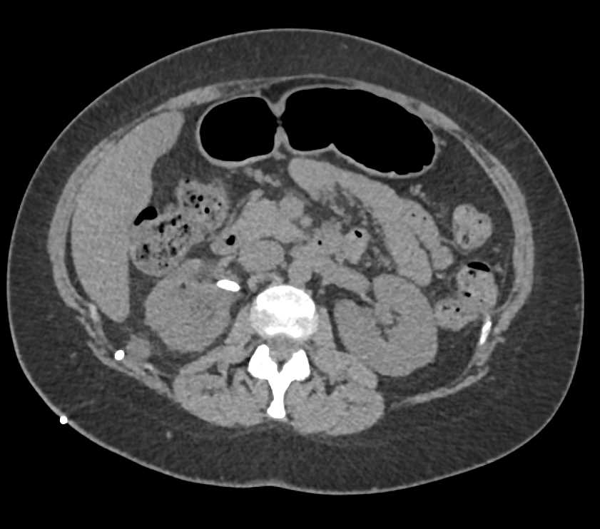 Transitional Cell Carcinoma (TCC) Right Ureter - CTisus CT Scan