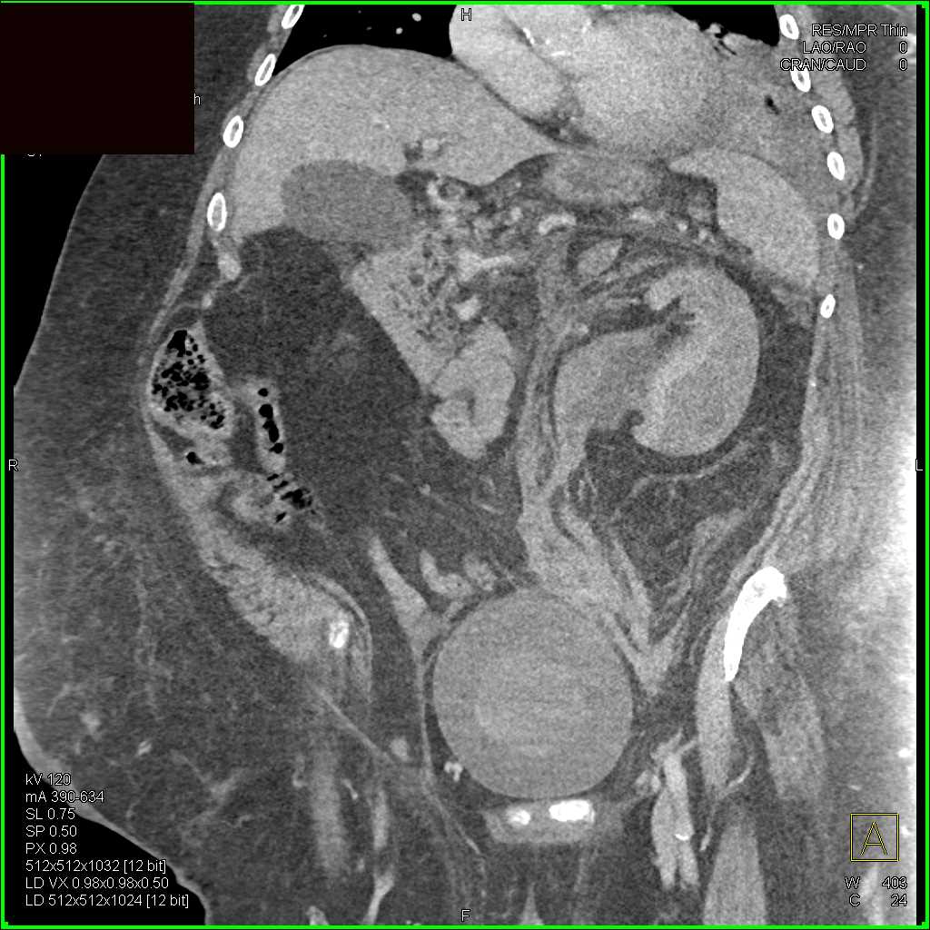 Left Renal Bleed with Blood in Ureter and Bladder - CTisus CT Scan