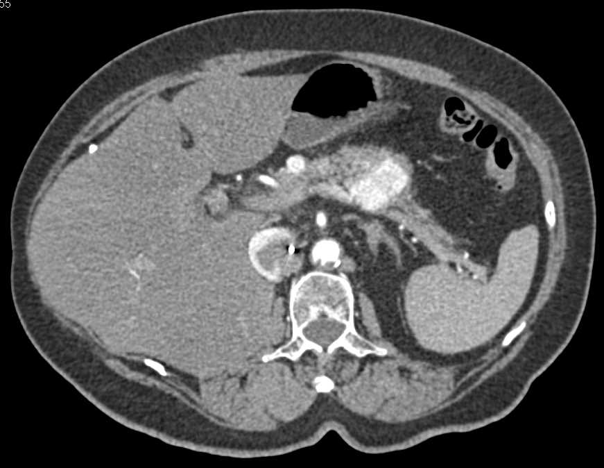 Metastatic Renal Cell Carcinoma to the Pancreas - CTisus CT Scan