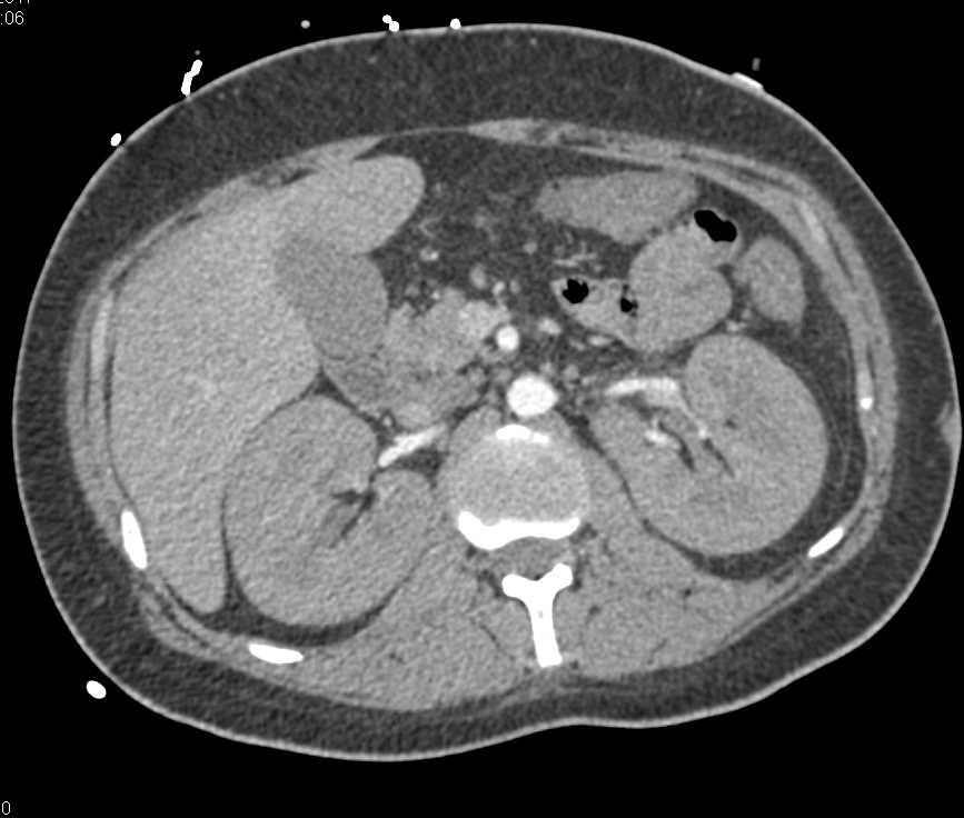 Enlarged Kidneys in a Patient with Leukemia - CTisus CT Scan