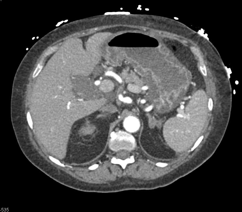 Pancreatitis in a Renal Transplant Patient - CTisus CT Scan