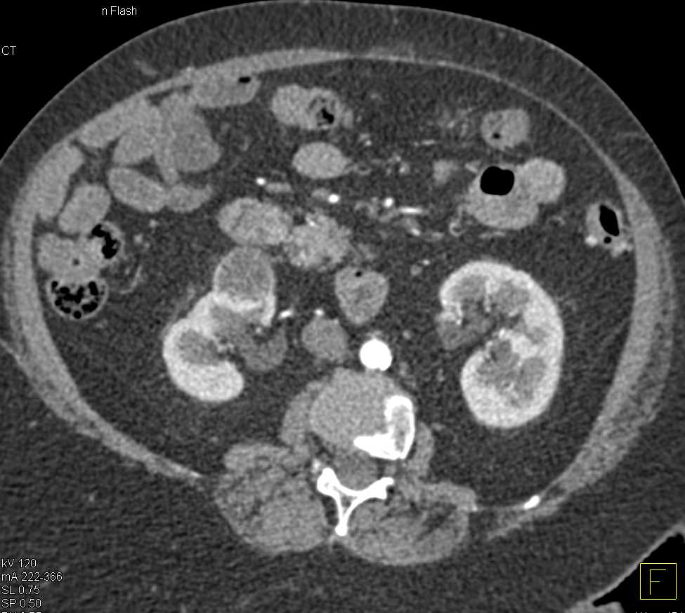 Papillary Renal cell Carcinoma - CTisus CT Scan