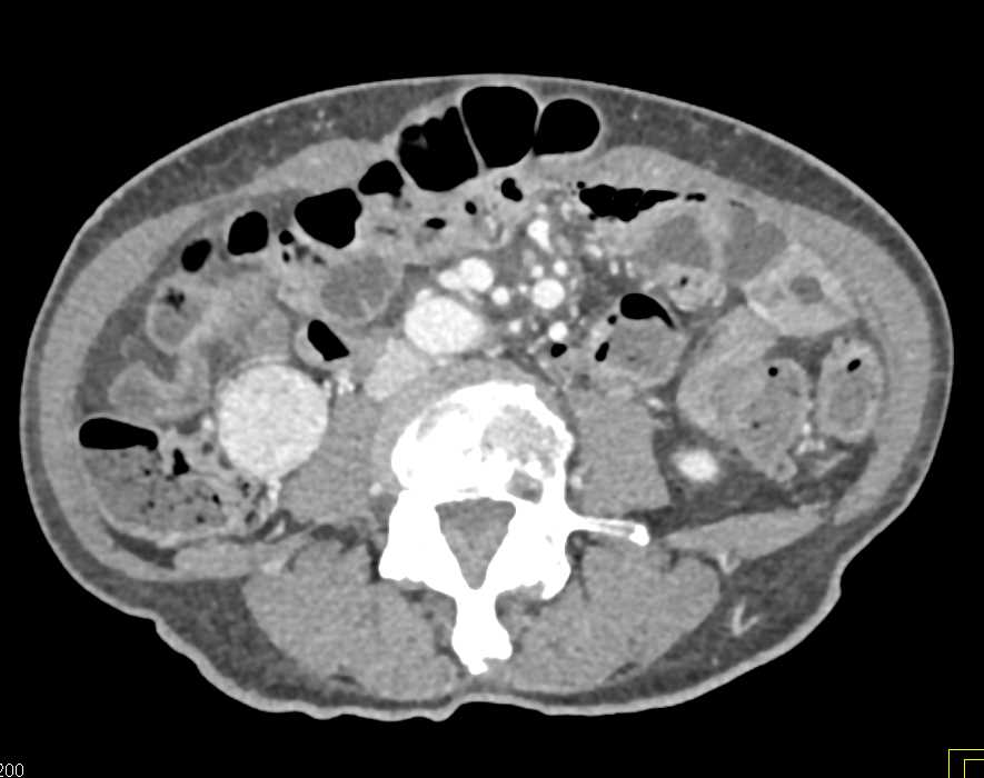 Papillary Renal Cell Carcinoma Right Kidney Lower Pole - CTisus CT Scan