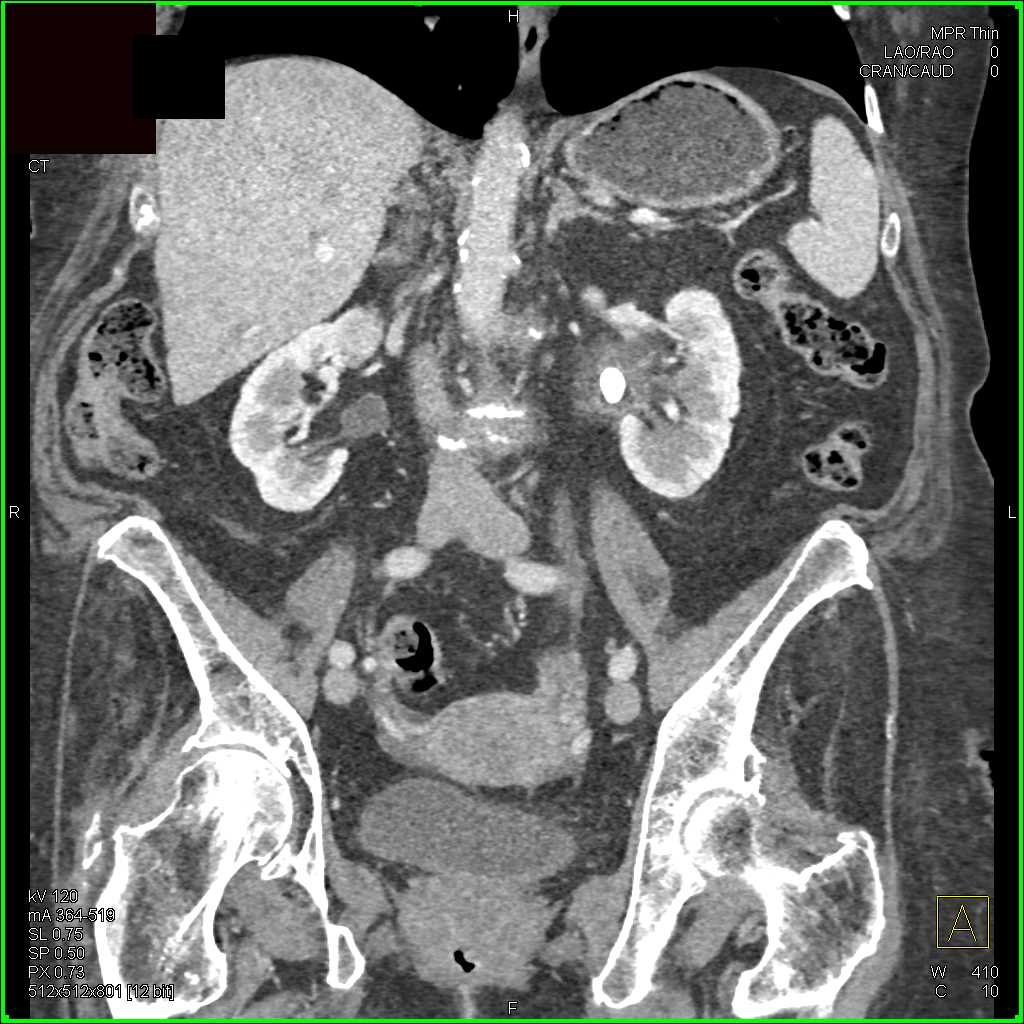 Obstructing Stone Left Renal Pelvis - CTisus CT Scan