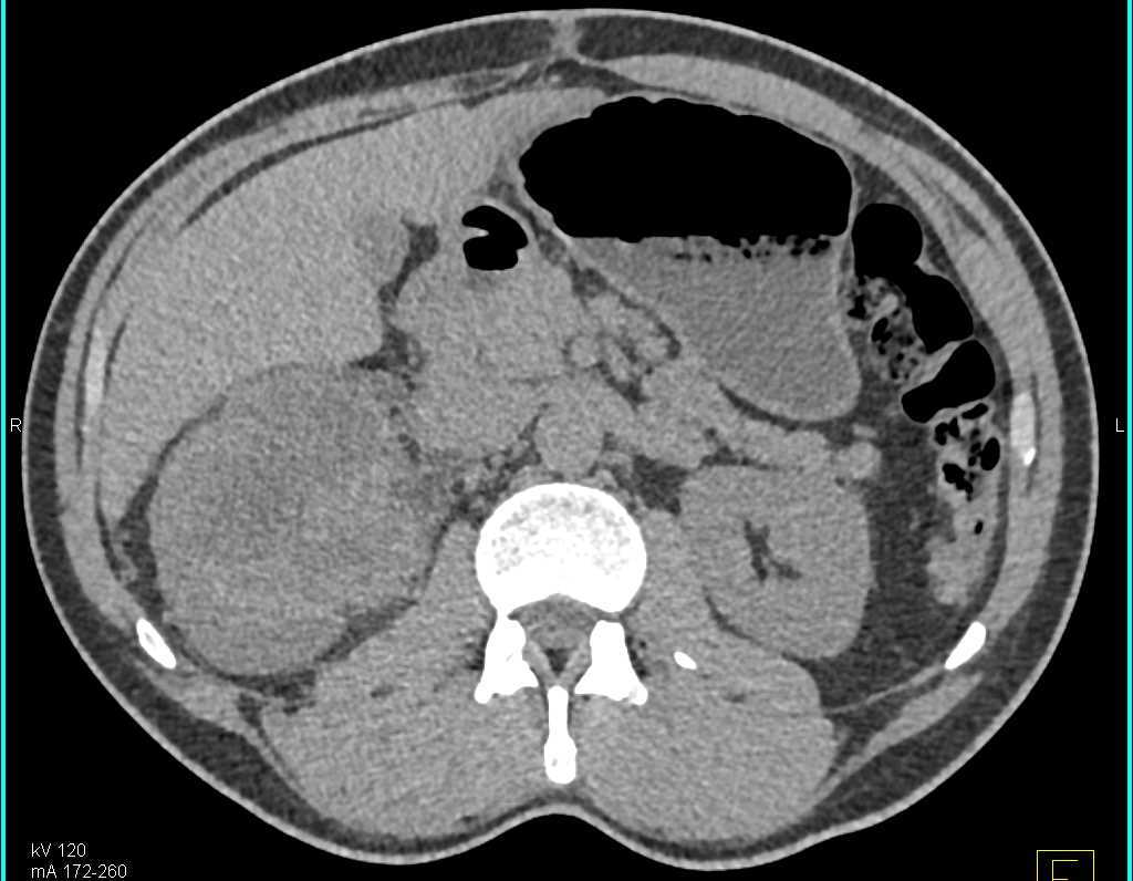 Infiltrating Clear Cell Carcinoma Right Kidney - CTisus CT Scan