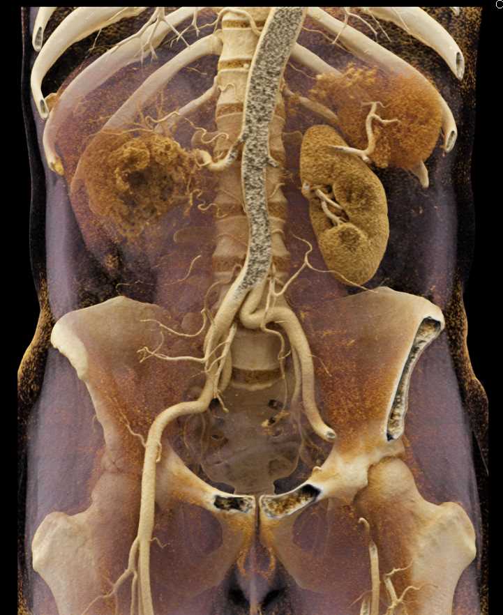 Infiltrating Clear Cell Carcinoma Right Kidney - CTisus CT Scan