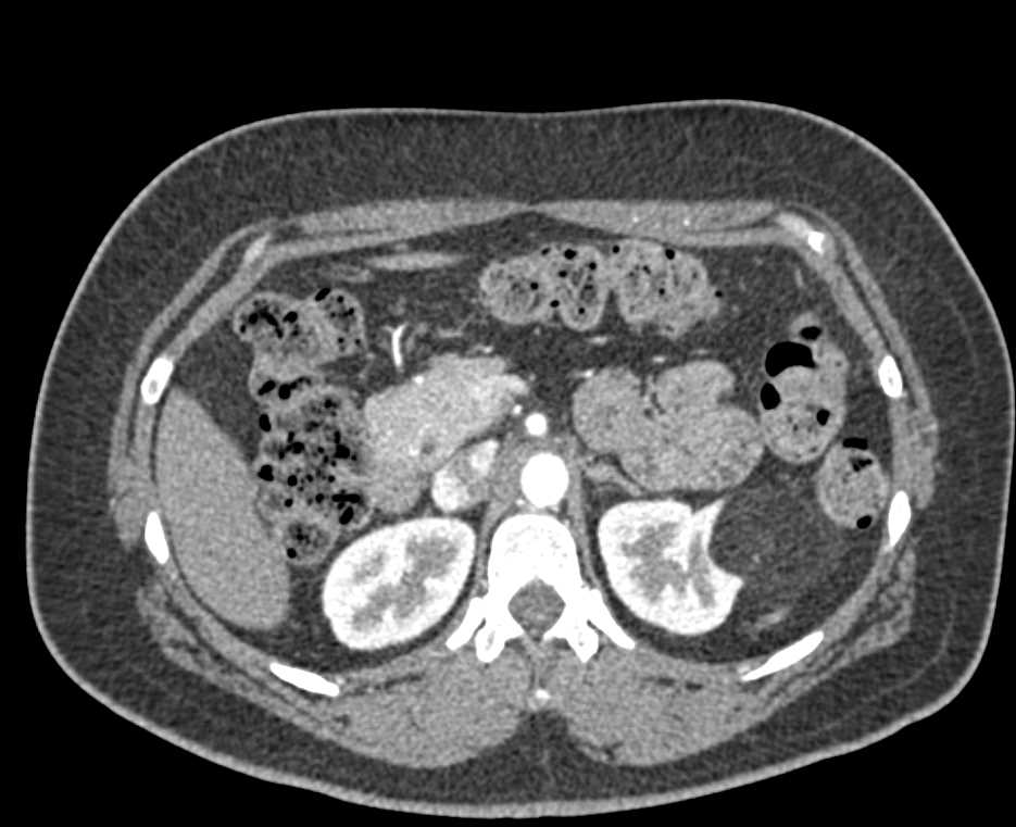 AML (angiomyolipoma) Left Kidney - CTisus CT Scan