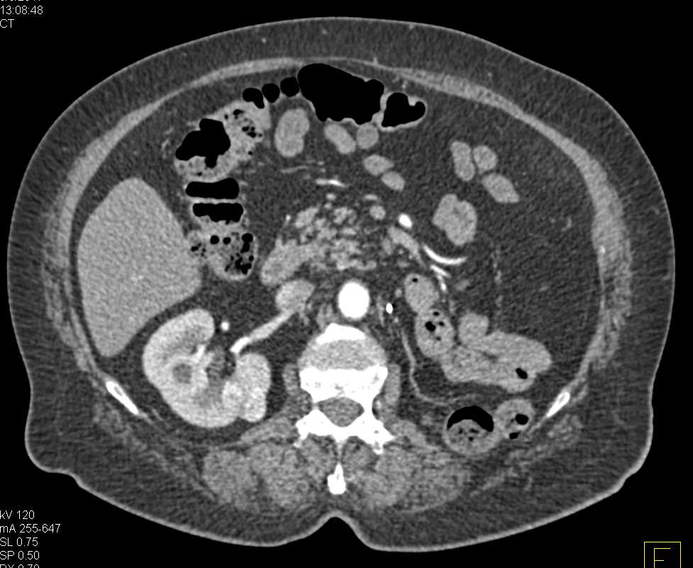 Renal Cell Carcinoma Right Kidney - CTisus CT Scan