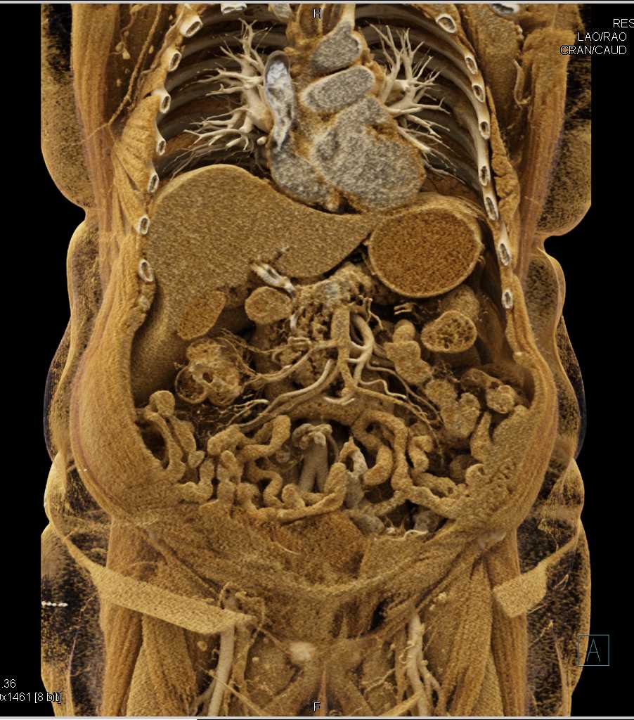 Renal Cell Carcinoma Right Kidney - CTisus CT Scan