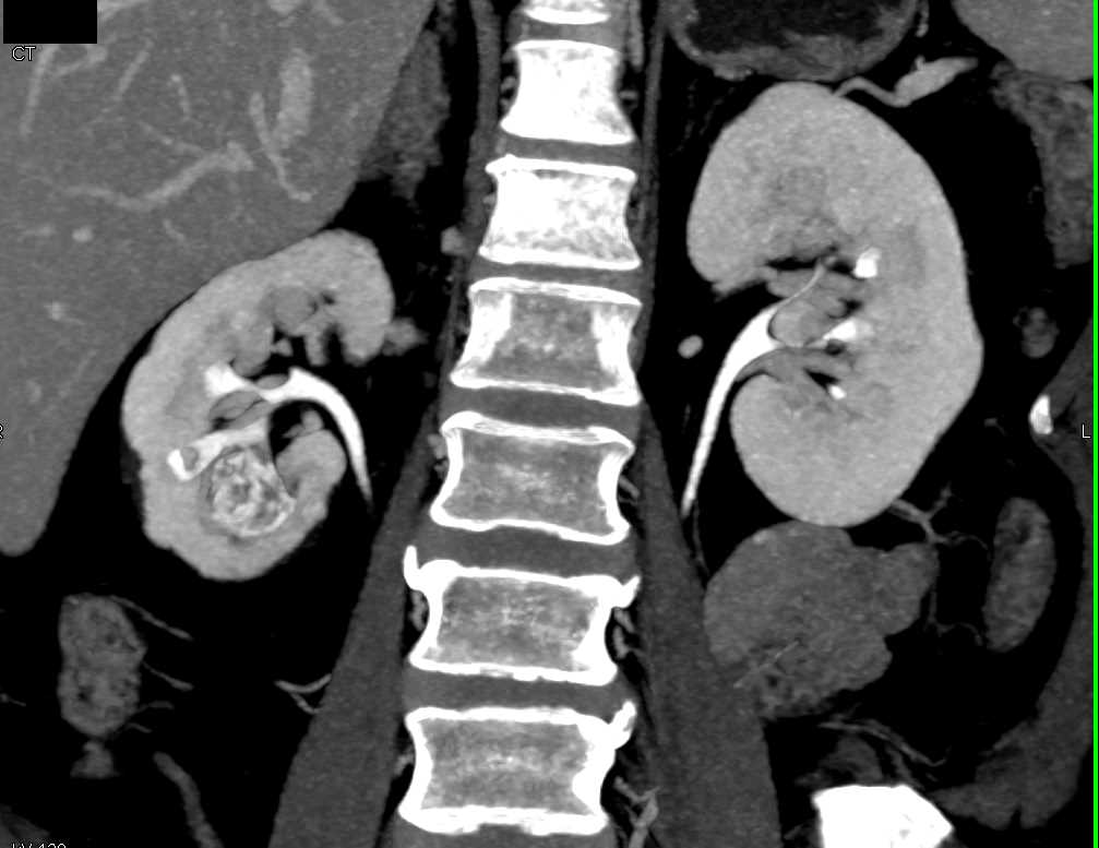 Tuberculosis (TB) of the Lower Pole of the Right Kidney - CTisus CT Scan