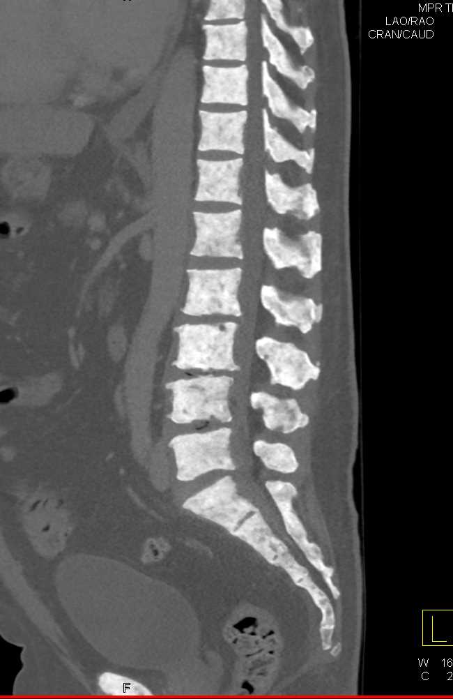 Renal Osteodystrophy - CTisus CT Scan