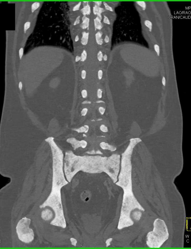 Renal Osteodystrophy - CTisus CT Scan