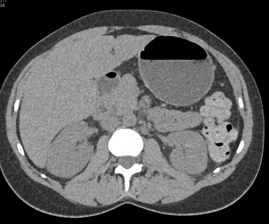 Acute Pyelonephritis - CTisus CT Scan