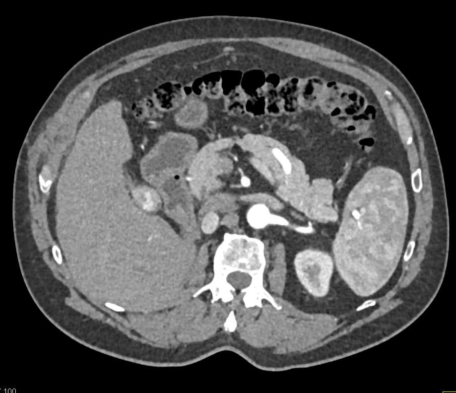 Recurrent Renal Cell Carcinoma Near Right Adrenal - CTisus CT Scan