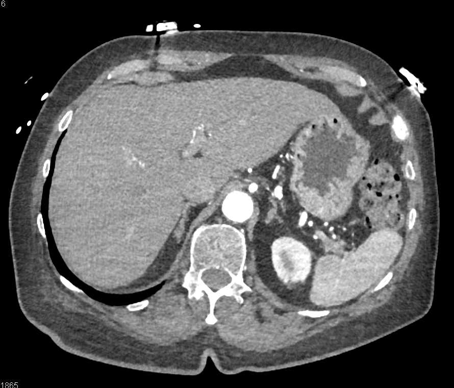 Infiltrating Transitional Cell Carcinoma (TCC) Right Kidney - CTisus CT Scan