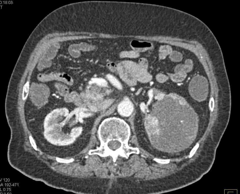 Bilateral Papillary Renal Cell Carcinoma - CTisus CT Scan