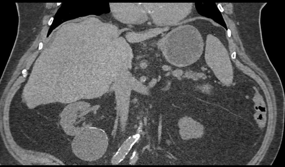 Bosniak 2F Renal Cyst - CTisus CT Scan