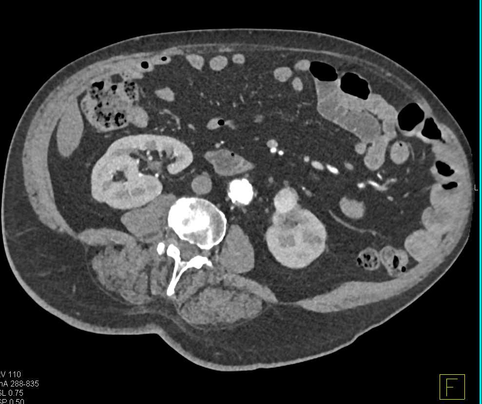 Papillary Renal Cell Carcinoma Left Kidney - CTisus CT Scan