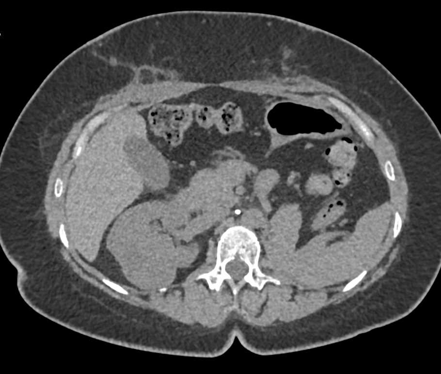 Renal Carcinoma with Contralateral Metastases and Bone Metastases - CTisus CT Scan