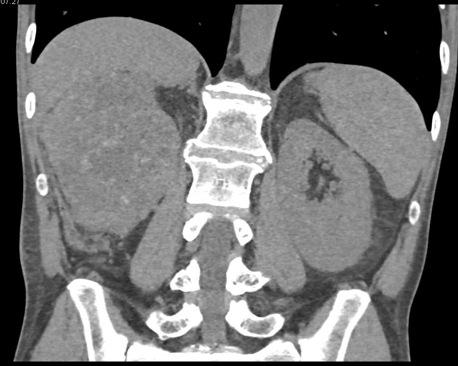 Clear Cell Renal Cell Carcinoma with Neovascularity - CTisus CT Scan