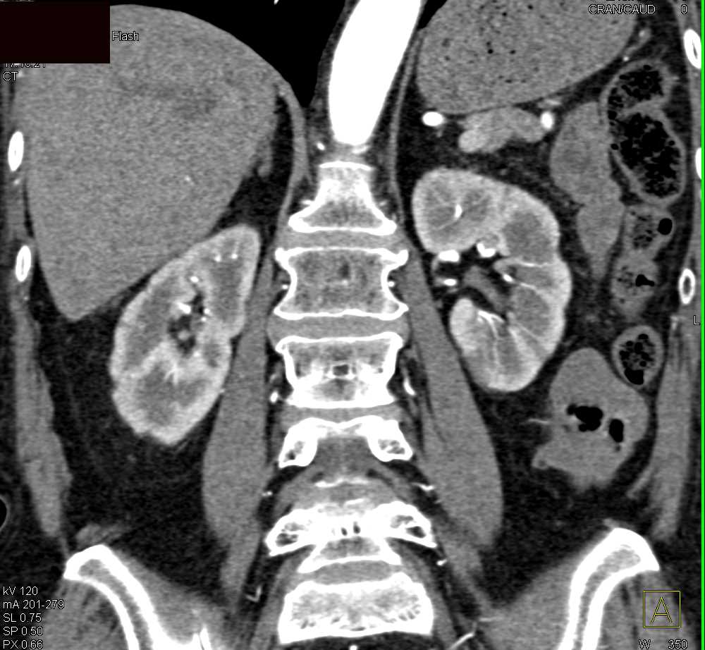 Papillary Necrosis - CTisus CT Scan