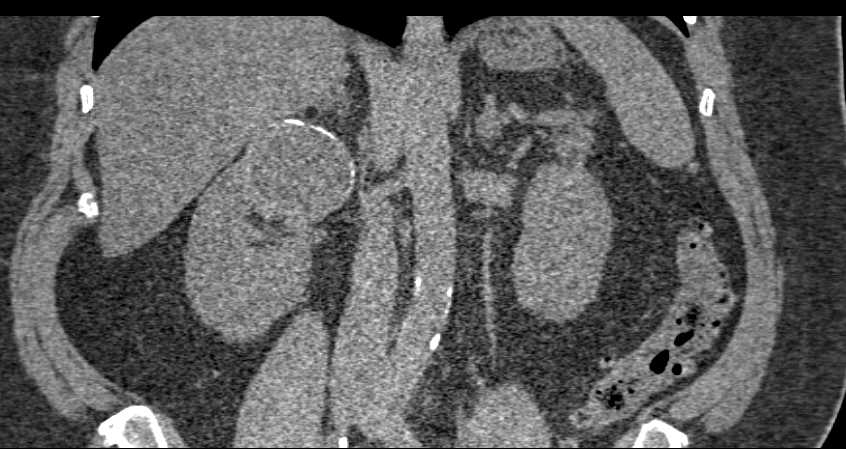 Cystic Renal Cell Carcinoma with Rim Calcification - CTisus CT Scan