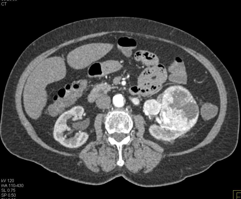 Clear Cell Carcinoma Left Kidney with Neovascularity - CTisus CT Scan