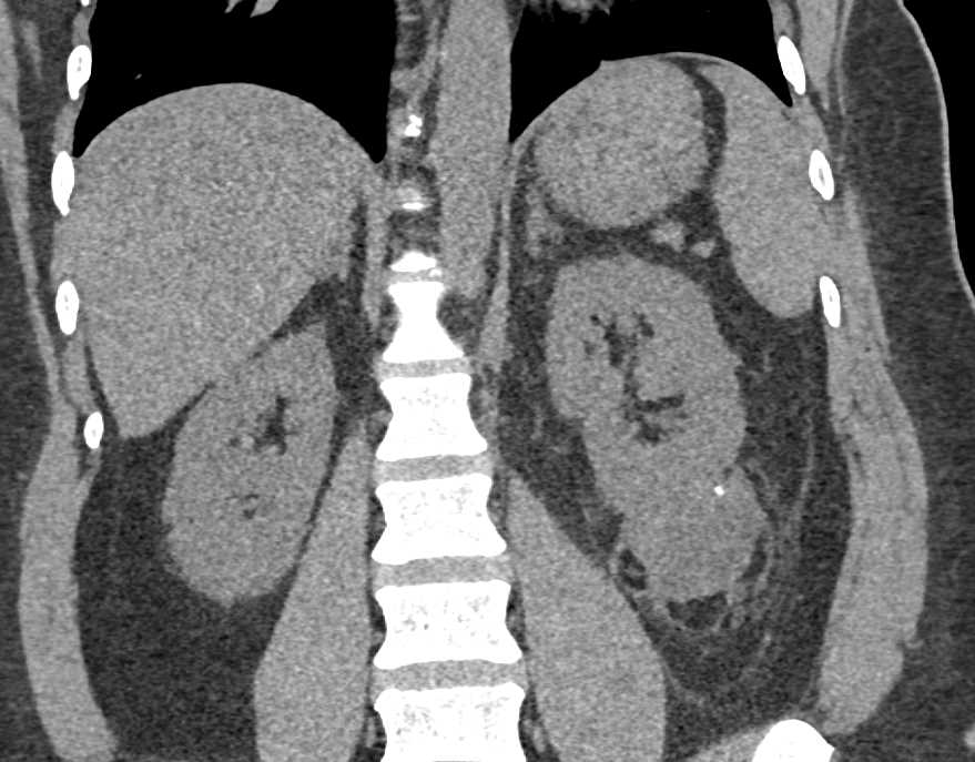 Complex Cyst Lower Pole Left Kidney - CTisus CT Scan