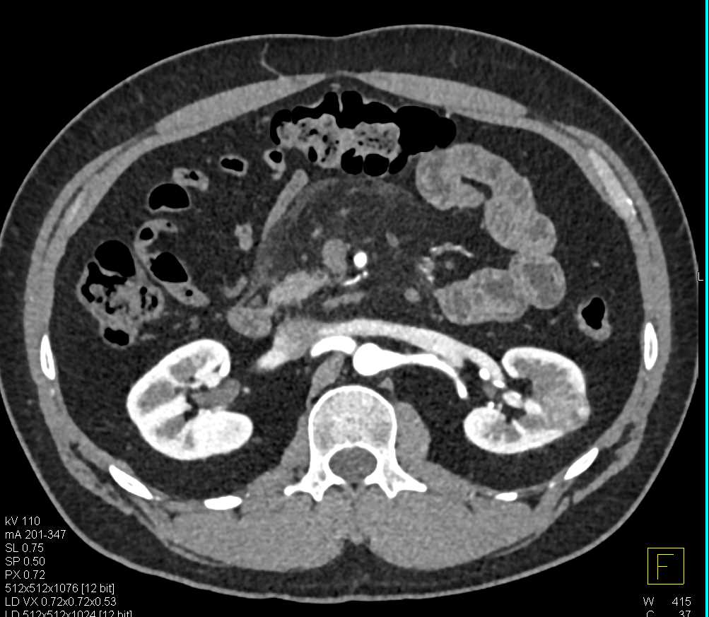 Papillary Left Renal Cell Carcinoma - CTisus CT Scan