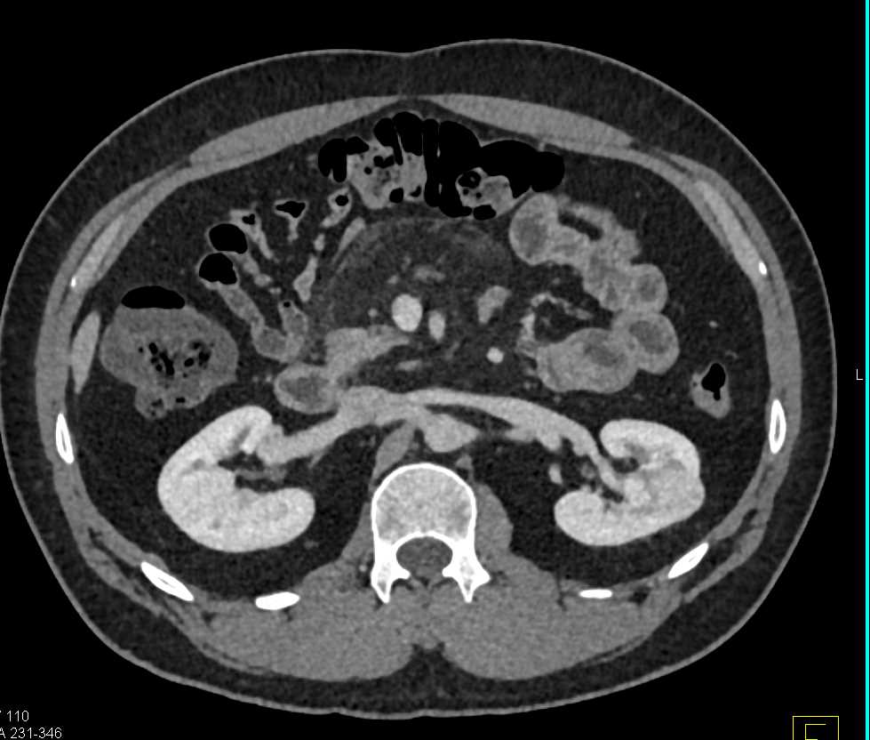 Papillary Left Renal Cell Carcinoma - CTisus CT Scan