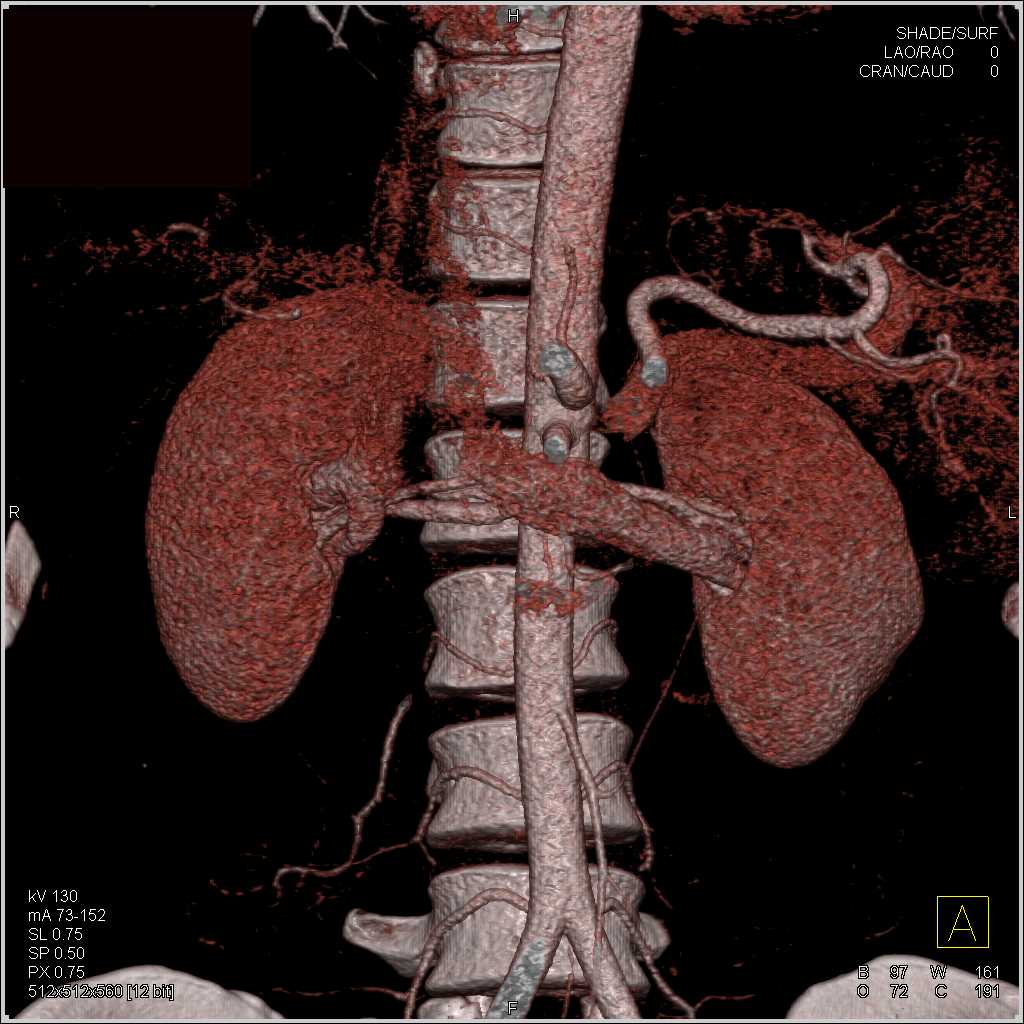 Renal Arteries and Veins in a Renal Donor - CTisus CT Scan