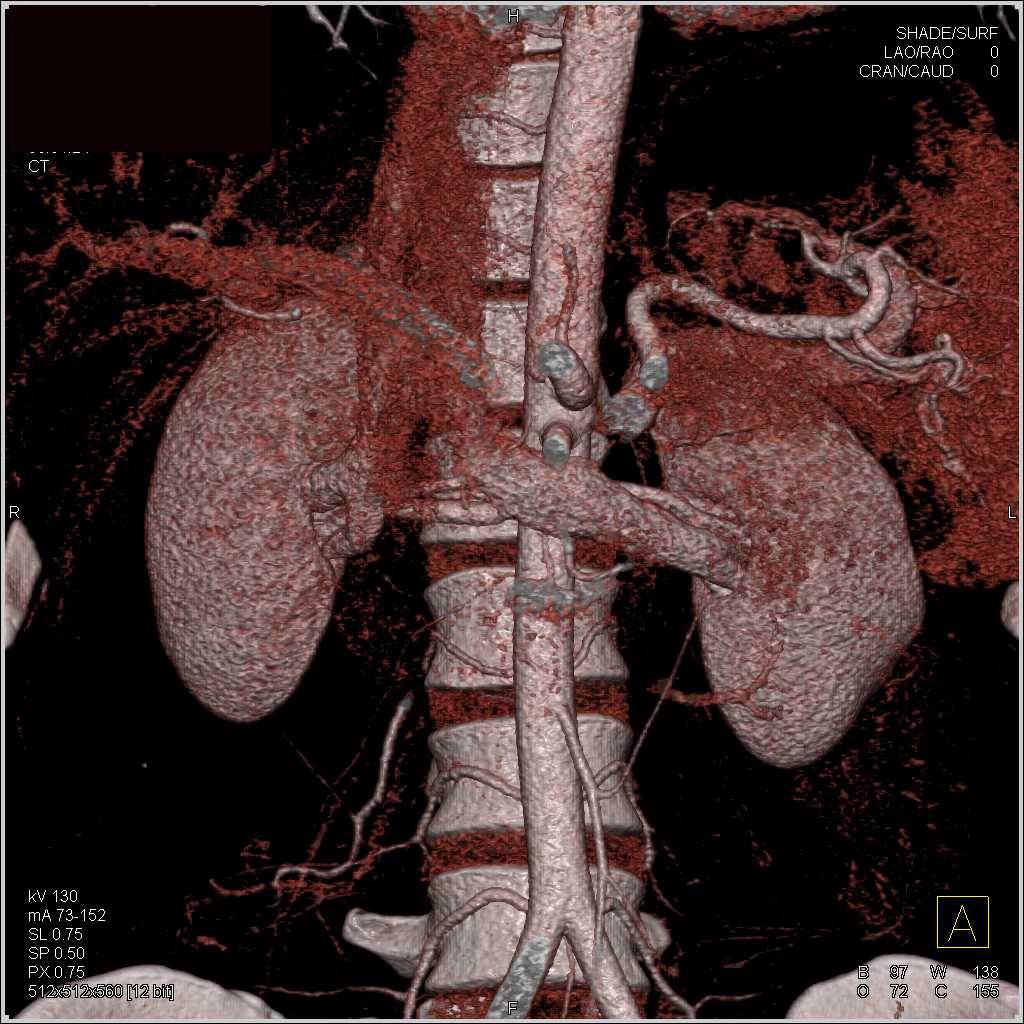 Renal Arteries and Veins in a Renal Donor - CTisus CT Scan