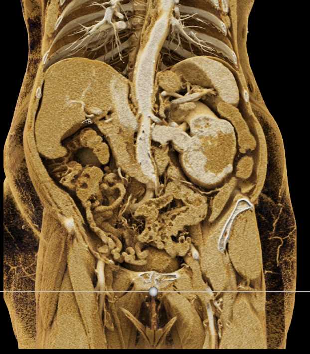 Clear Cell Renal Cell Carcinoma Invades the Left Renal Vein - CTisus CT Scan