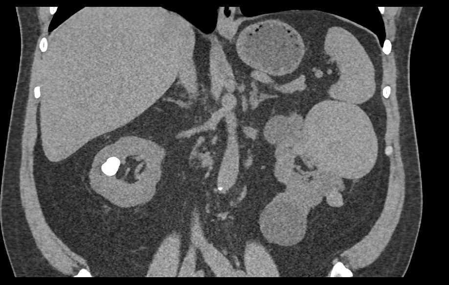 High Density Left Renal Cyst - CTisus CT Scan