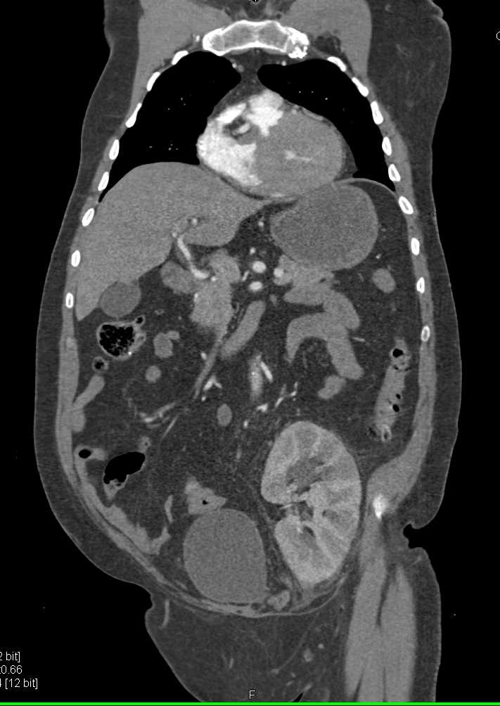 Acute Pyelonephritis in a Renal Transplant Kidney - CTisus CT Scan