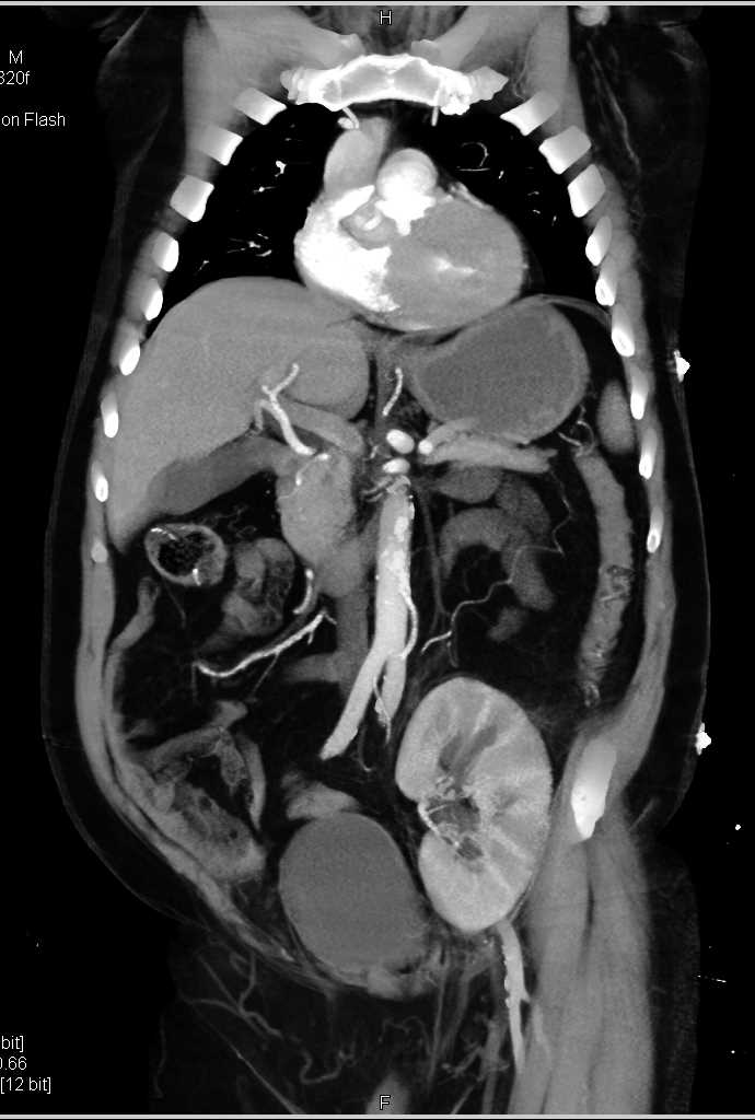 Acute Pyelonephritis In A Renal Transplant Kidney Kidney Case Studies