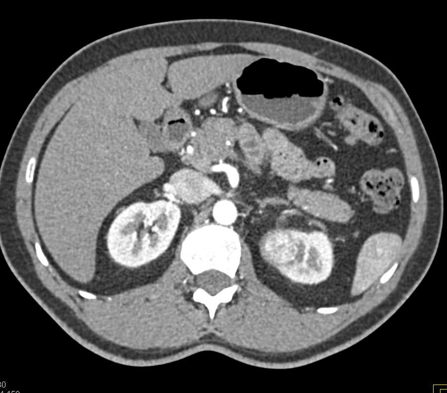 Renal Cell Carcinoma Upper Pole Left Kidney - CTisus CT Scan