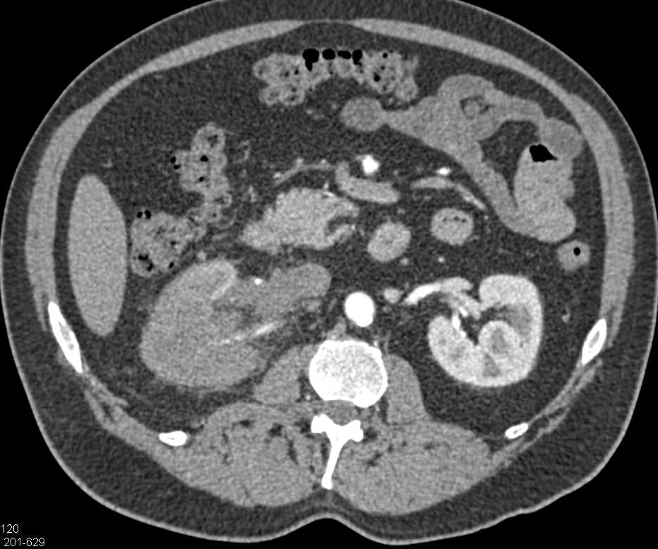 Transitional Cell Carcinoma (TCC) Right Kidney Involves the Renal Vein - CTisus CT Scan