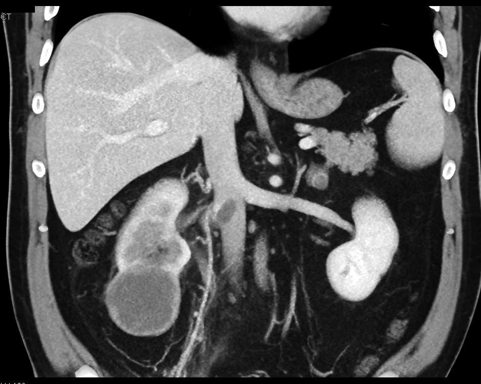 Transitional Cell Carcinoma (TCC) Right Kidney Involves the Renal Vein - CTisus CT Scan