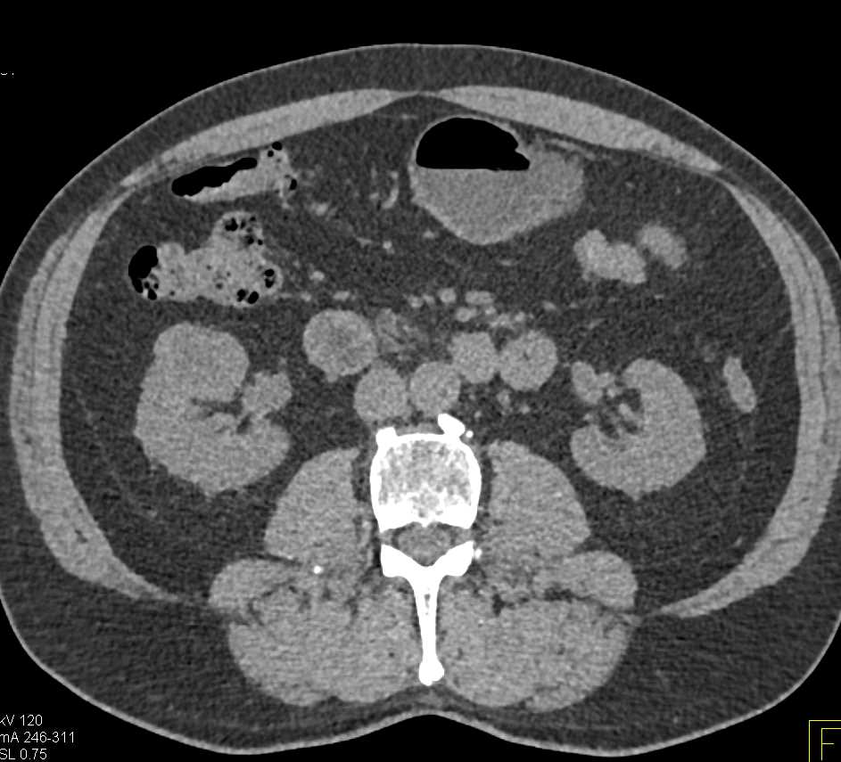 Cystic Right Renal Cell Carcinoma - CTisus CT Scan