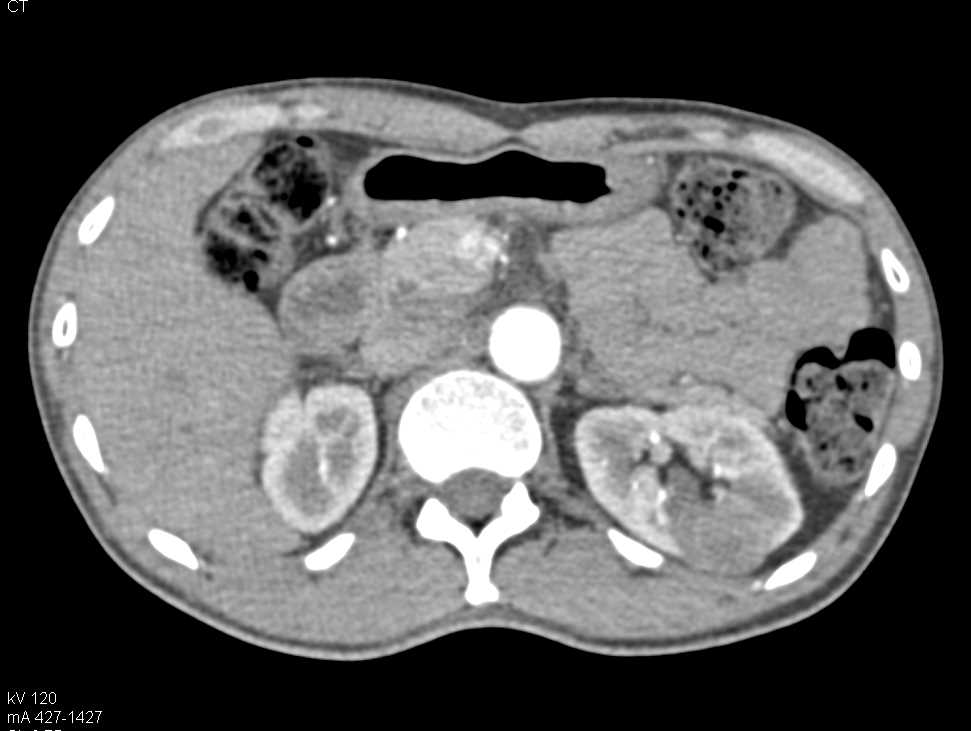 Left renal Abscess - CTisus CT Scan