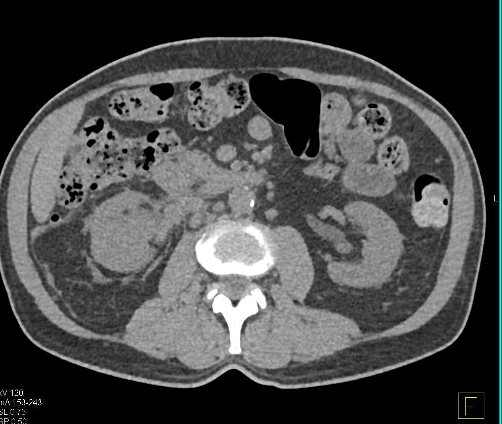 Transitional Cell Carcinoma Right Renal Pelvis - CTisus CT Scan