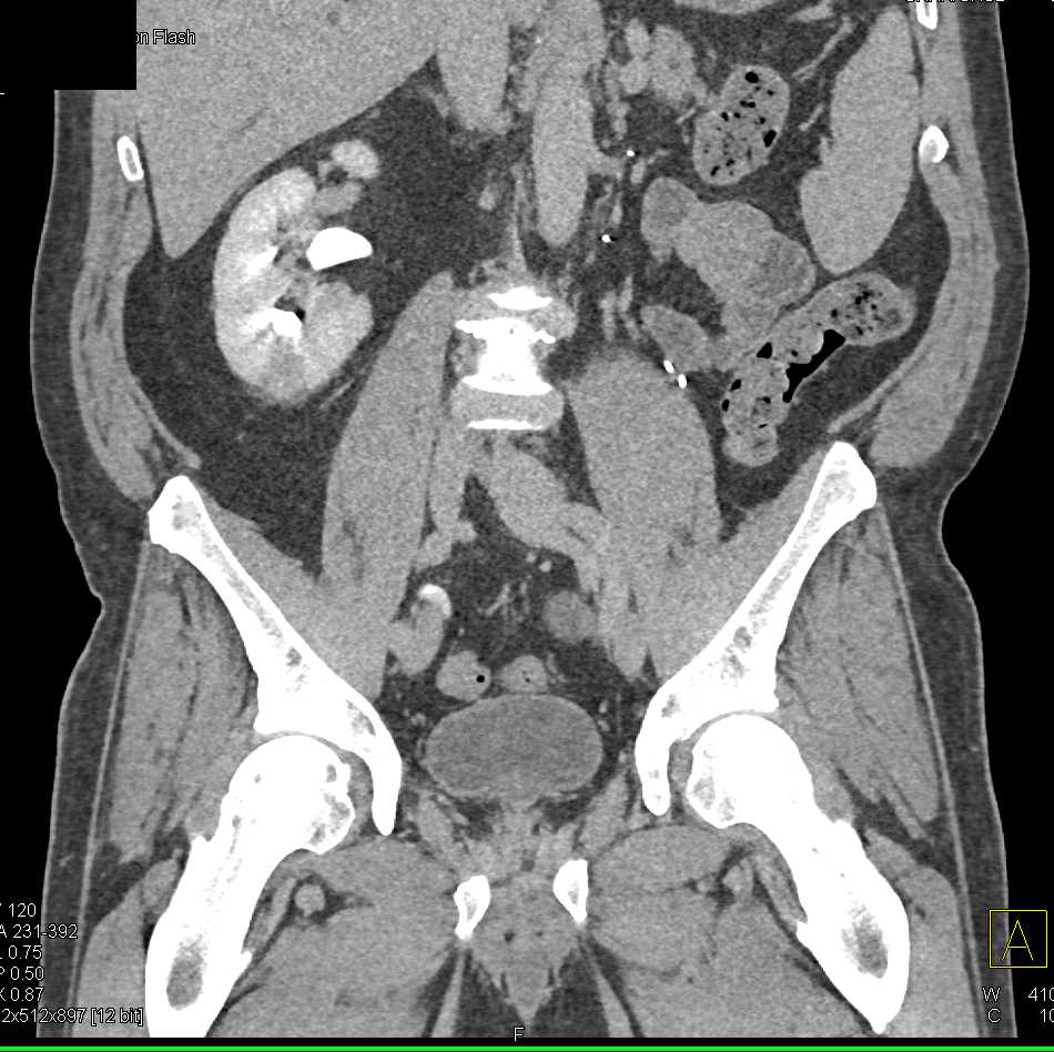 Acute Pyelonephritis Right Kidney - CTisus CT Scan
