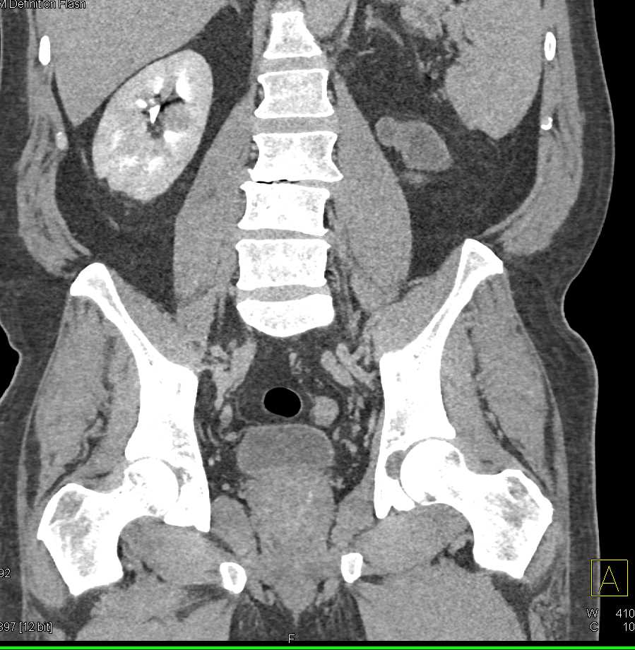 Acute pyelonephritis: Video, Anatomy & Definition