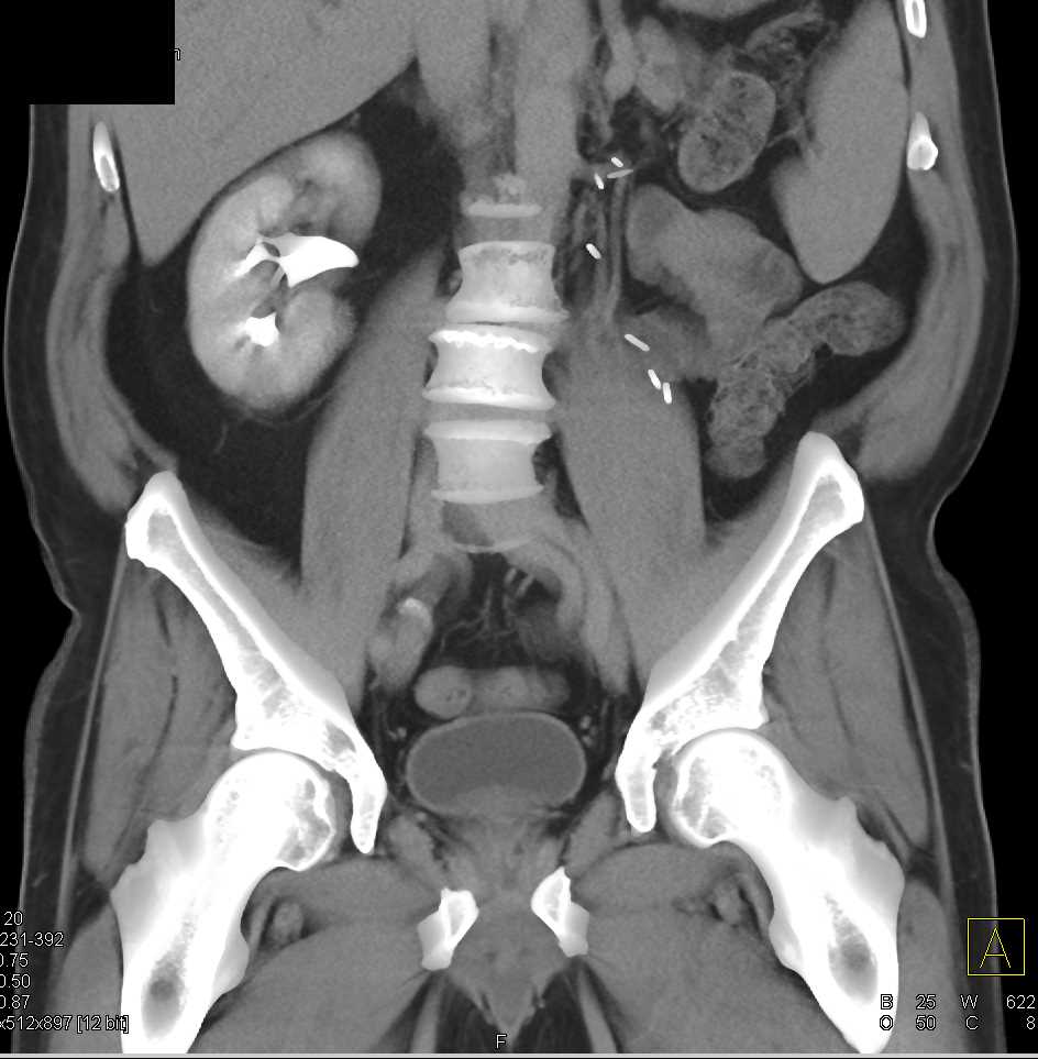 Acute pyelonephritis: Video, Anatomy & Definition