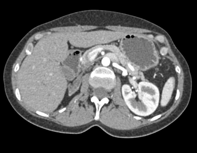Atrophic Right Kidney - CTisus CT Scan