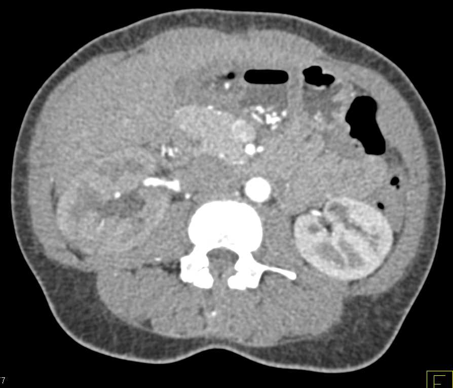 Obstructed Right Kidney due to Ureteral Calculi - CTisus CT Scan